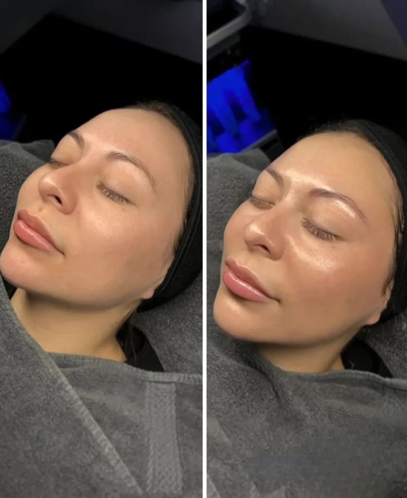 Your Post-HydraFacial Glow Game Plan