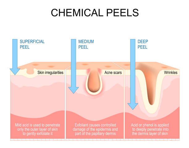 Diagram of skin layers showing effects of chemical peels for superficial, medium, and deep treatments on skin irregularities, acne